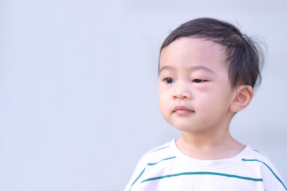 mata-bengkak-pada-anak