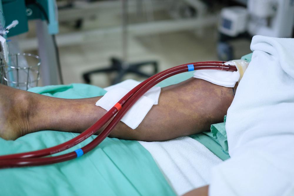 critical-limb-ischemia