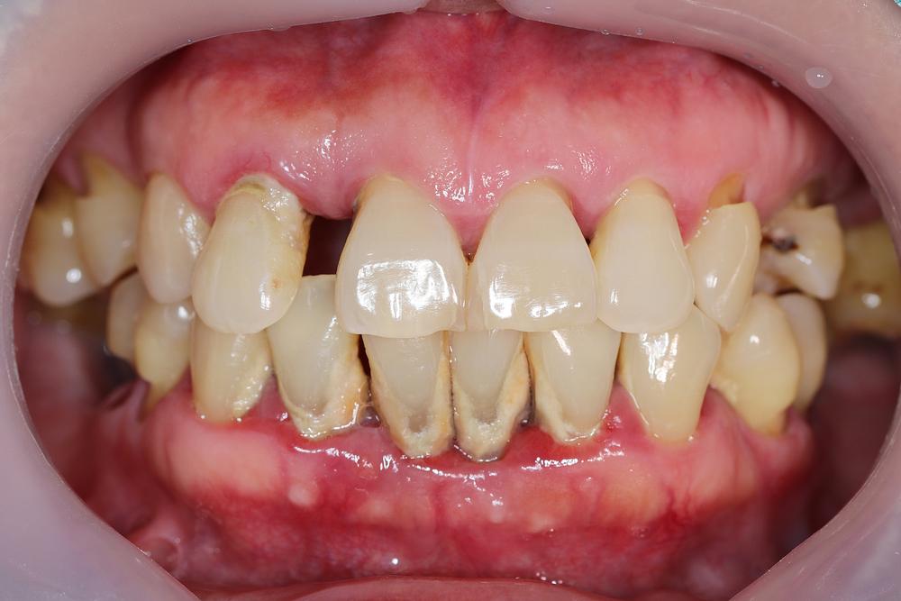 trench-mouth