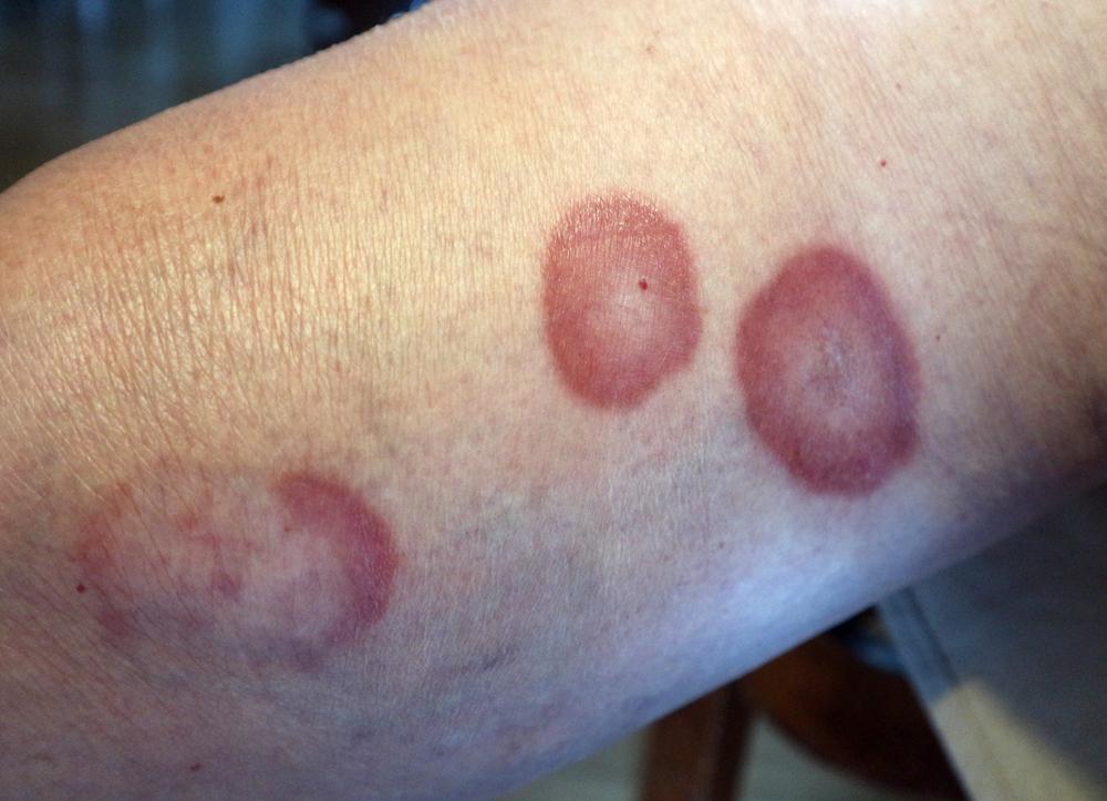 disseminated-granuloma-annulare