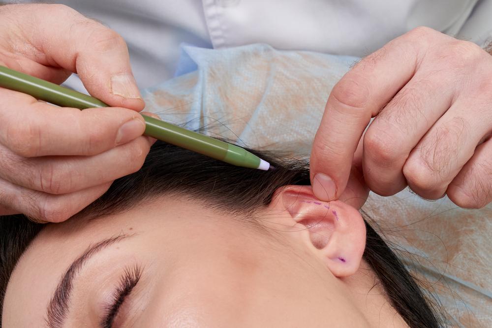 prosedur-otoplasty