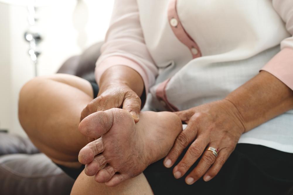Cara Merawat Kulit Pasien Diabetes, Cegah Komplikasi Lebih Lanjut