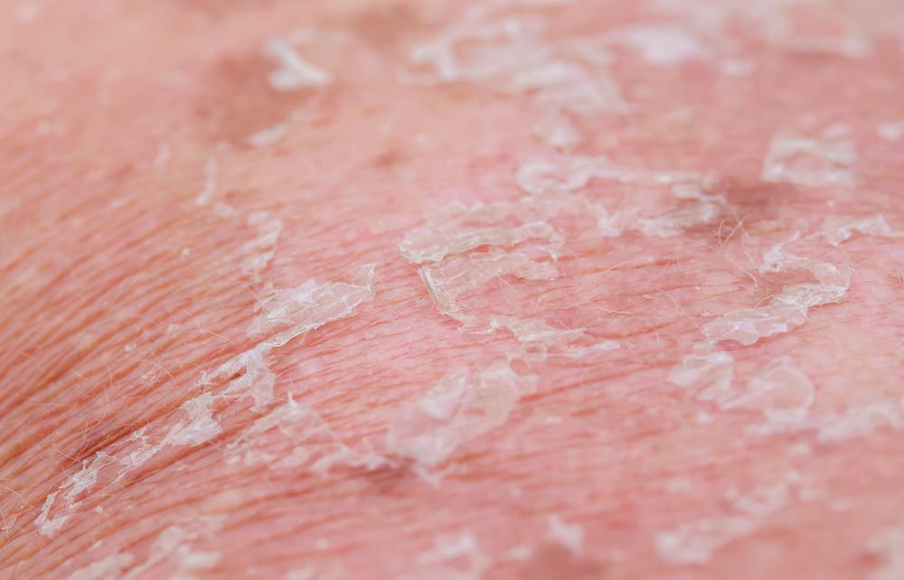 dermatitis-neglecta
