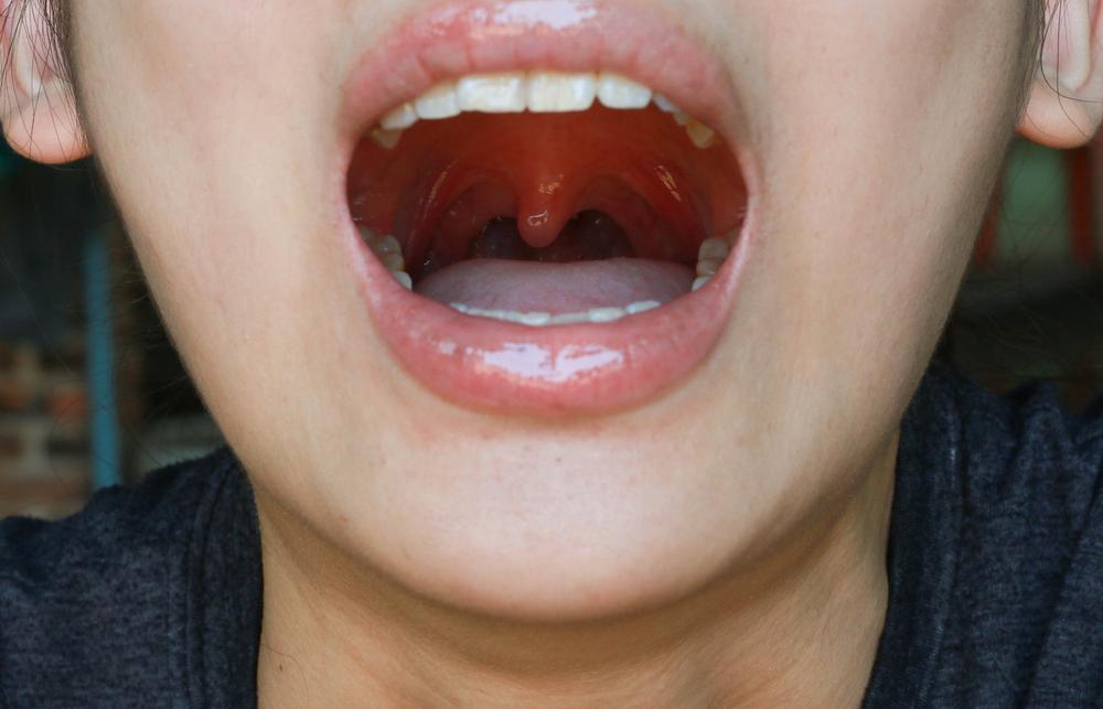 uvula-bengkak