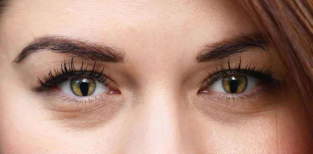 coloboma