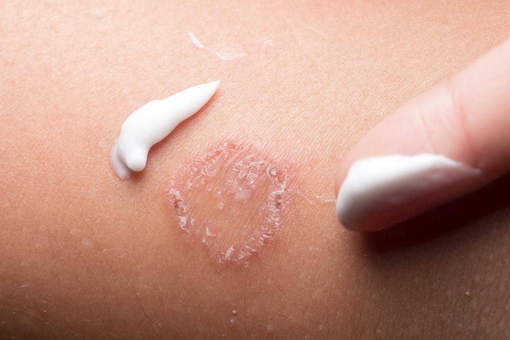 tanda-infeksi-jamur-sembuh