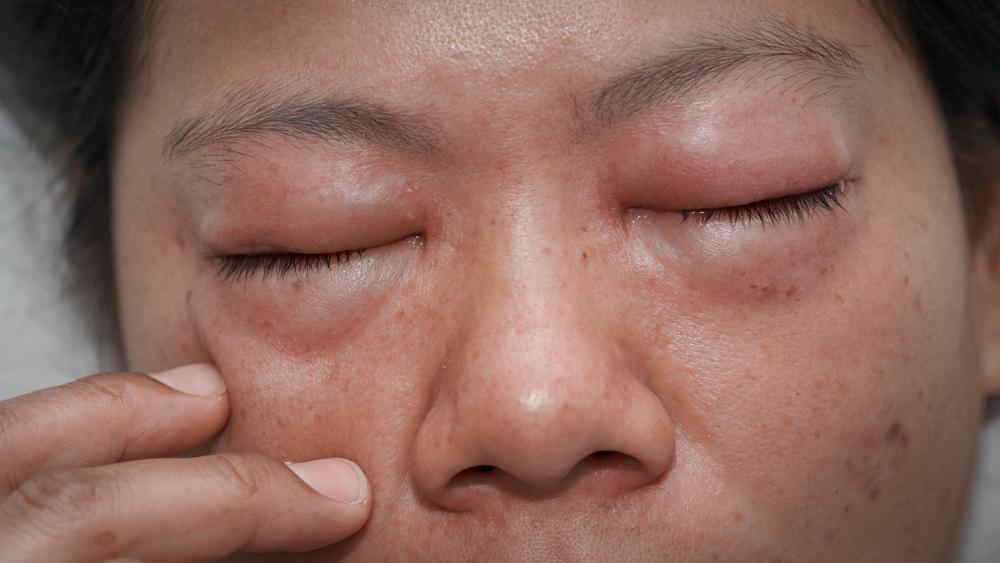 selulitis-orbita