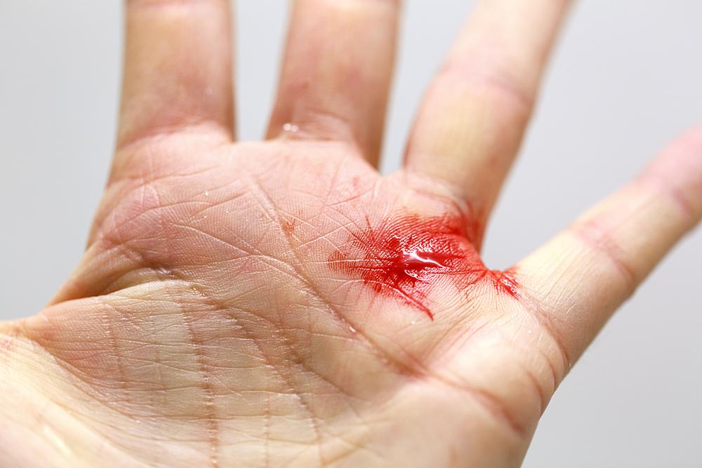 Pertolongan Pertama Jika Tangan dan Bagian Tubuh Lain Luka Kena Kaca
