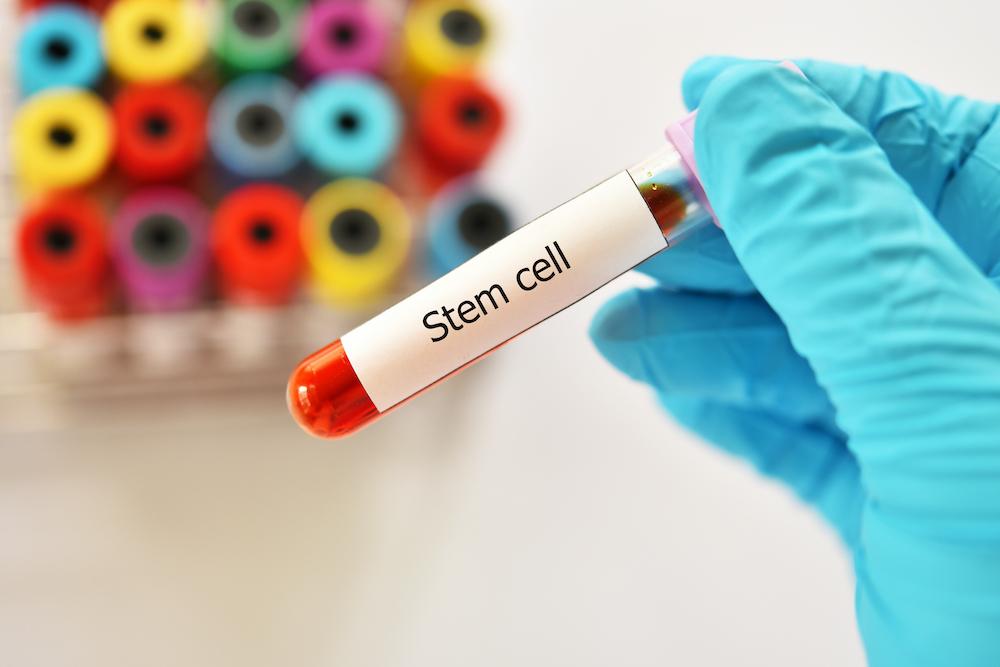 Terapi Sel Punca, Apakah Dapat Menyembuhkan HIV?