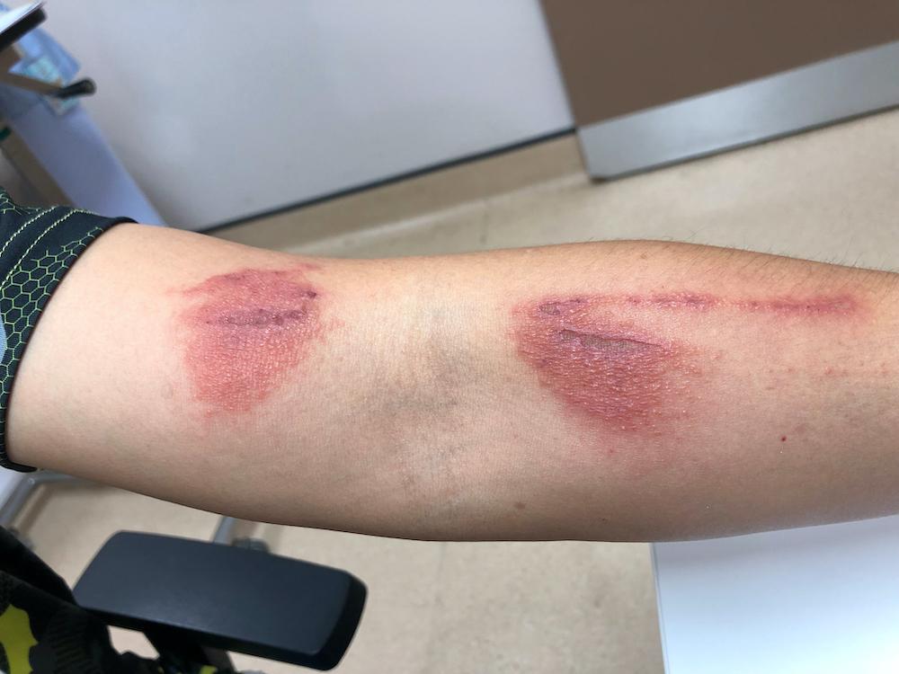 penyebab-dermatitis-kontak