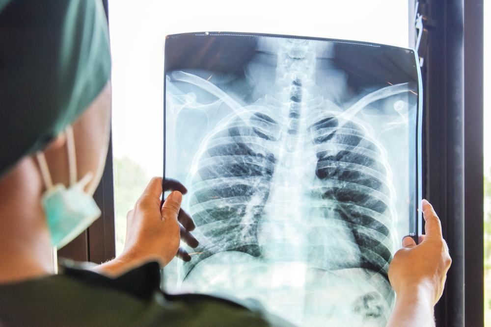 pneumonia-dan-paru-paru-basah