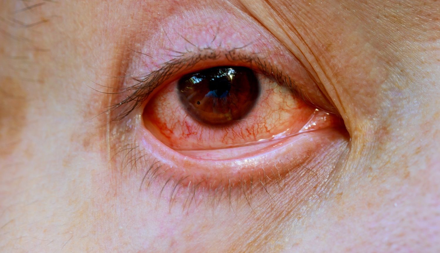 toksoplasmosis-pada-mata
