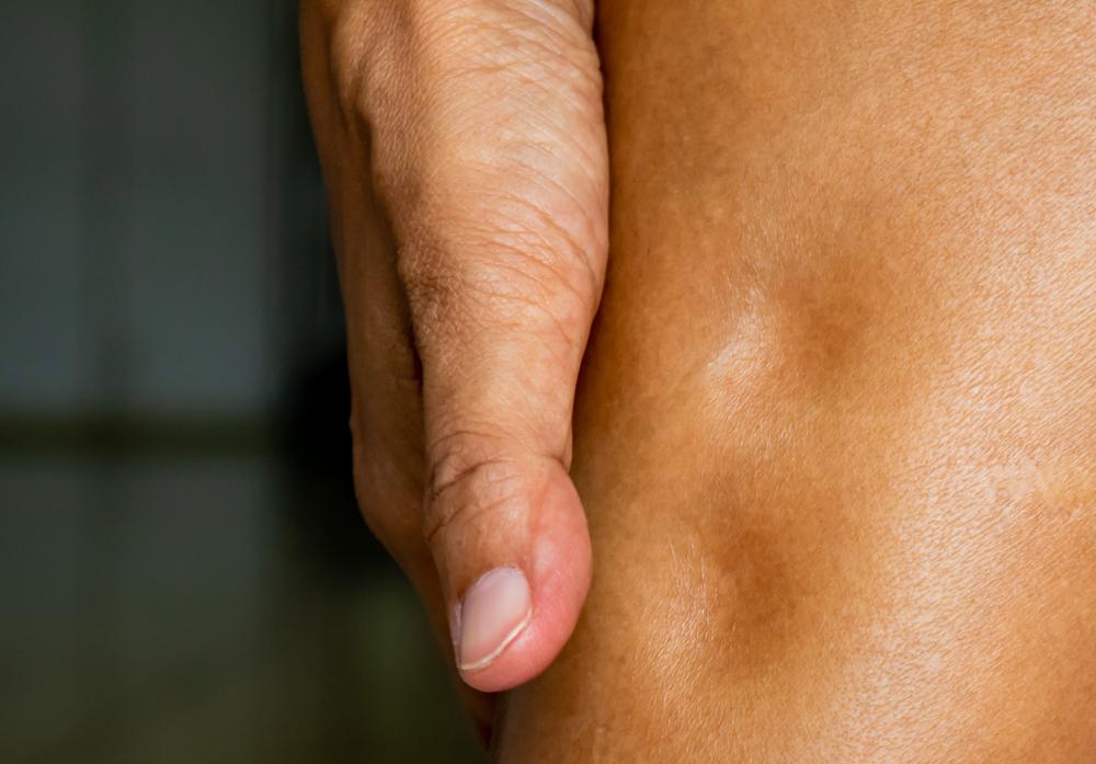 pitting-edema