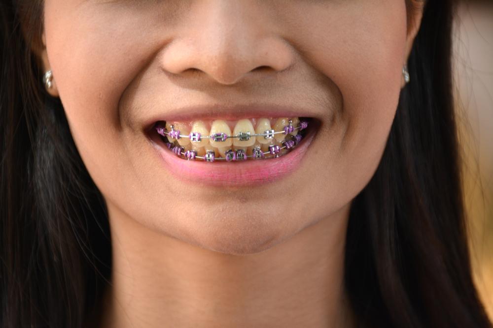 bracket-behel-tertelan
