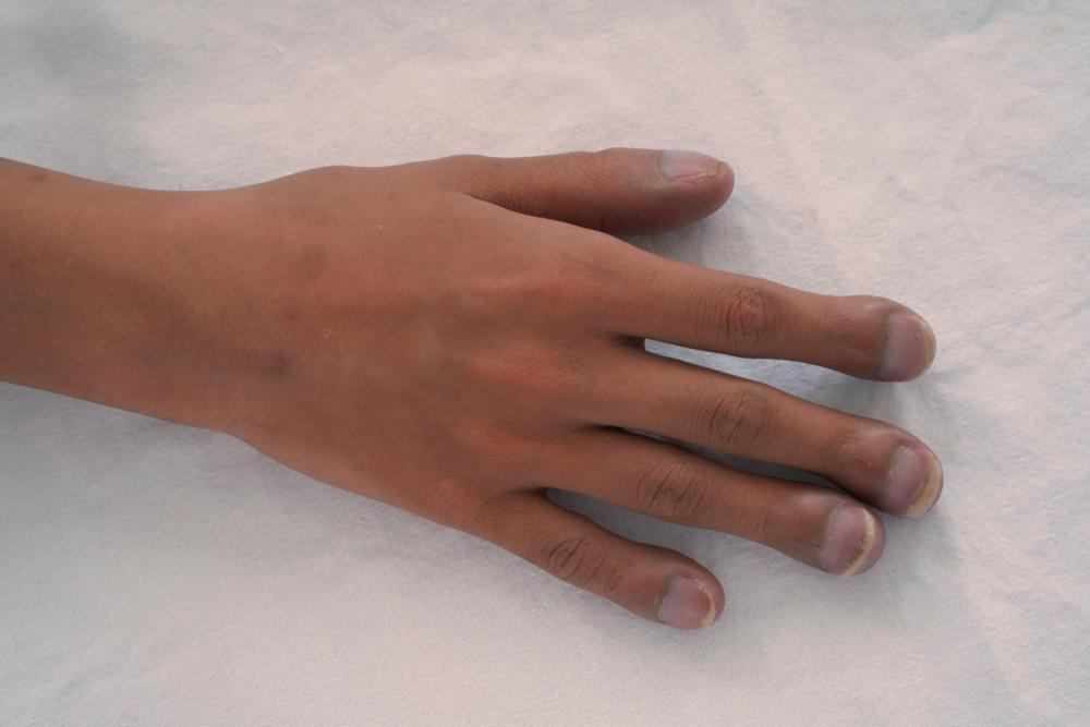 clubbing-finger