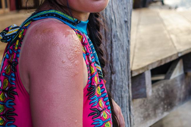 erythropoietic-protoporphyria