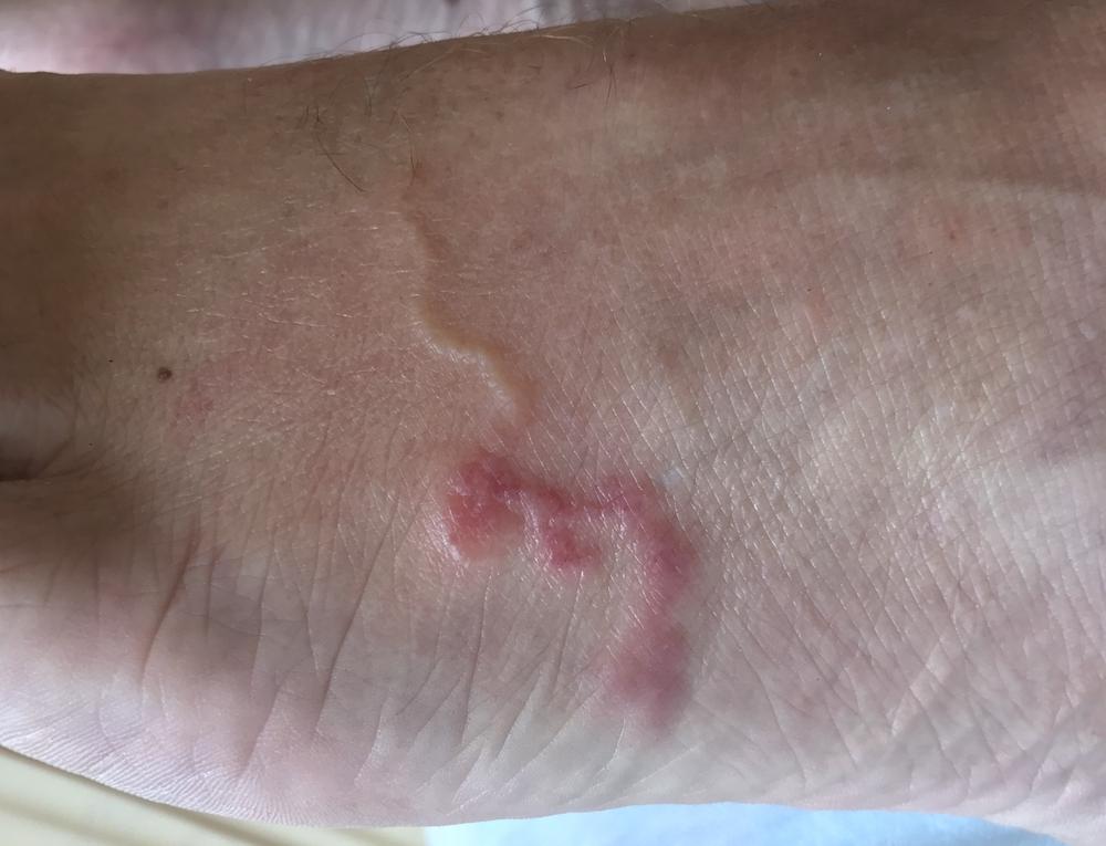 Cutaneous Larva Migrans, Ketika Cacing Menginfeksi Kulit