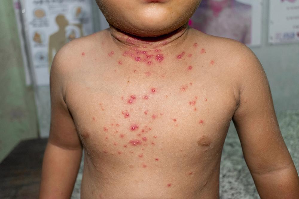 Waspada Cacar Monyet pada Anak dan Bayi, Begini Penularannya