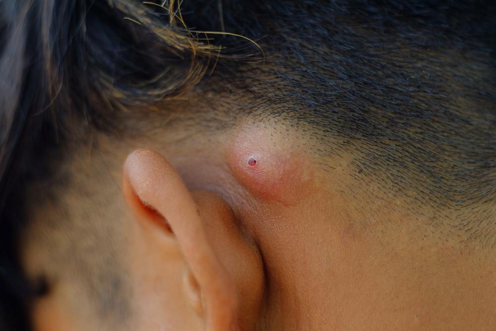 cara-mengobati-bisul-yang-sudah-pecah-tapi-masih-keras