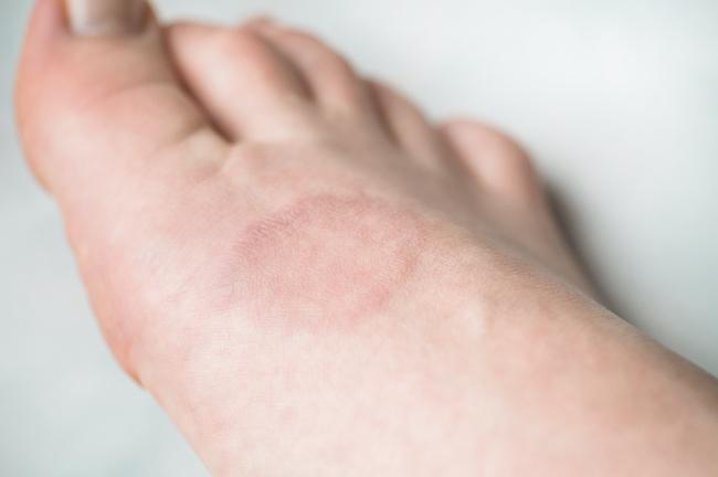 8 Cara yang Membantu Hilangkan Bekas Luka di Kaki