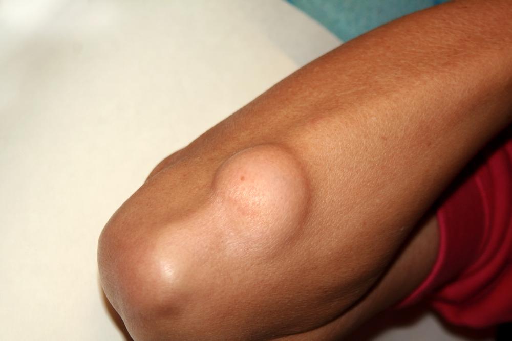 kanker-liposarcoma