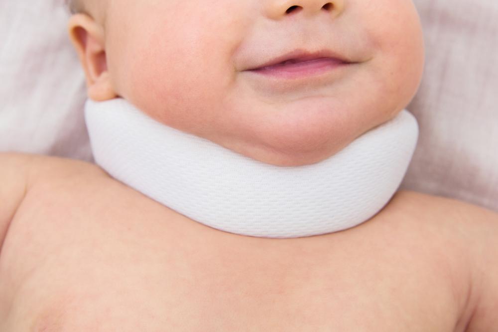 Tortikolis pada Bayi, Ketika Kepalanya Terlihat Miring ke Satu Sisi