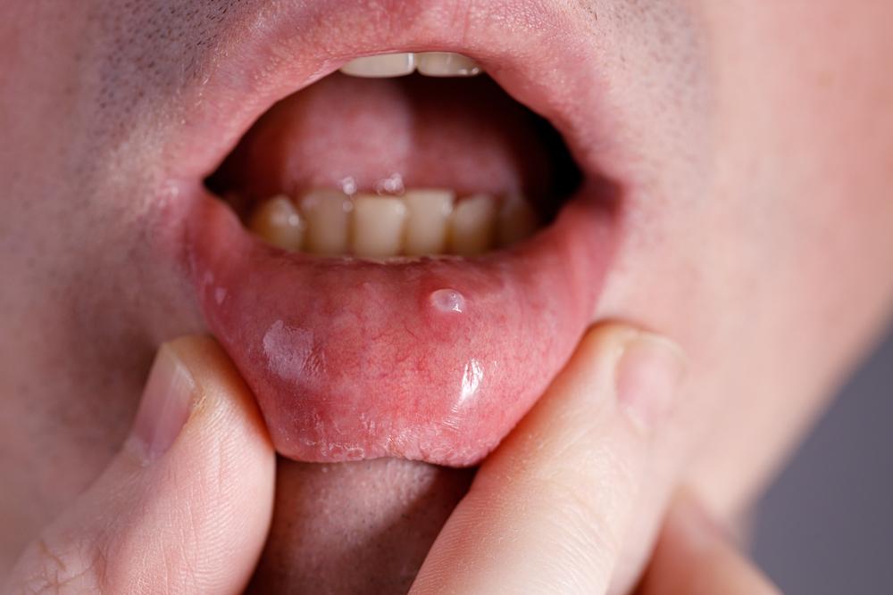 cara-menghilangkan-mucocele