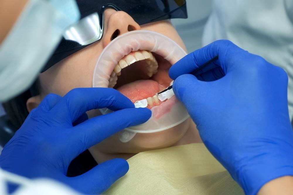 cara-melepas-veneer-gigi