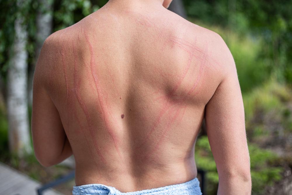 dermatographia
