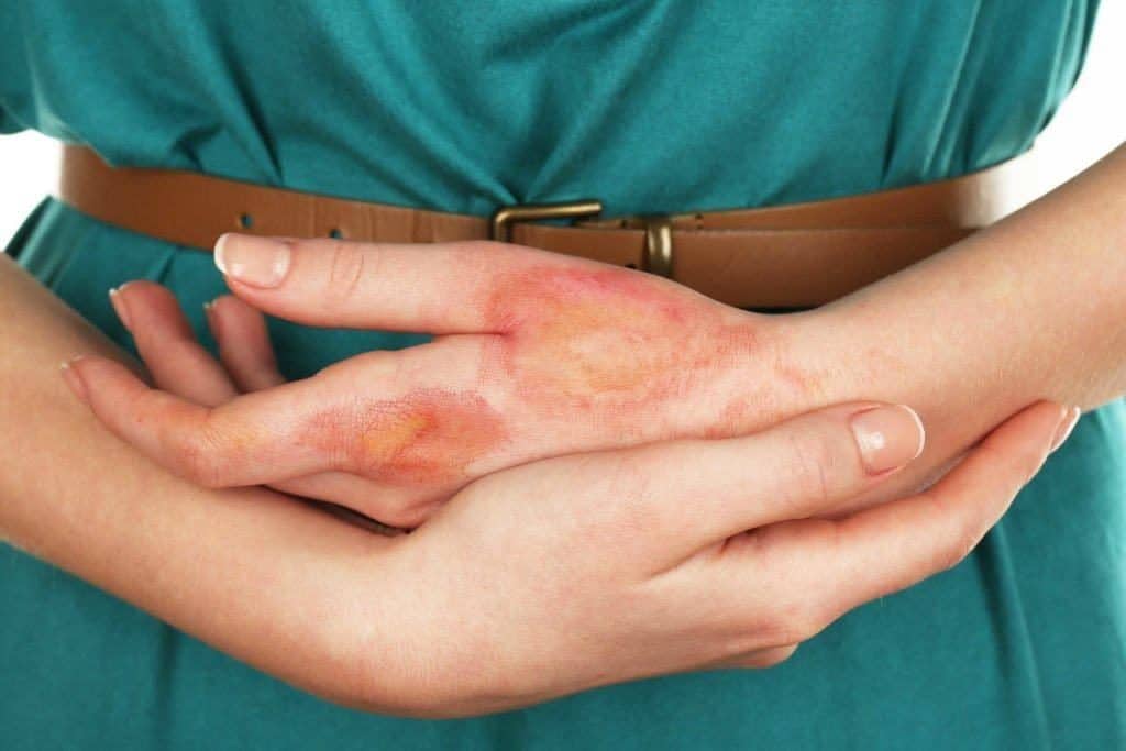 Dermatitis Numularis (Eksim Diskoid)