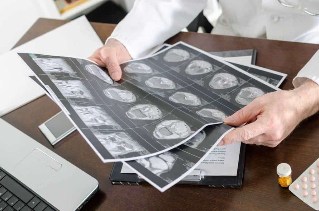 Waspada Stroke Ringan, Terjadi Sementara Tetapi Bisa Bahaya