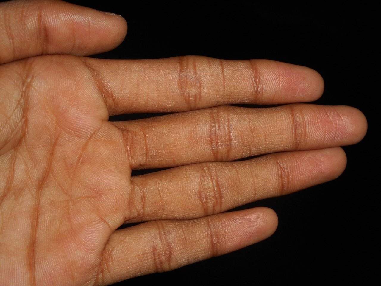 Sering Membunyikan Jari Tangan, Apakah Berbahaya?